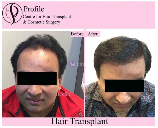 Profile Hair Transplant Centre 
