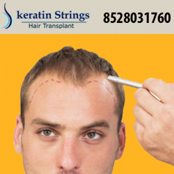 Hair Transplant  Clinic In Jammu